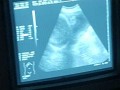 المغرب اليوم - الولايات المتحدة تُطور اختبار جديد للحوامل يكشف الإضرابات الوراثية قبل ولادة الجنين