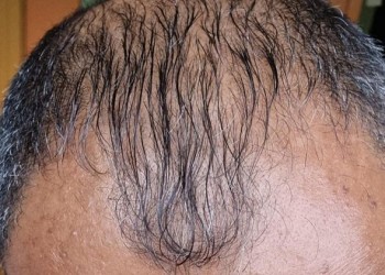 المغرب اليوم - تجارب سريرية تكشف عن فاعلية عالية لعلاج جديد للصلع