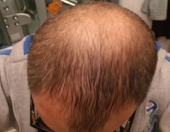 المغرب اليوم - دراسة تكشف أن الخلايا الجذعية لبصيلات الشعر تصبح صلبة مما يعوق نمو الشعر